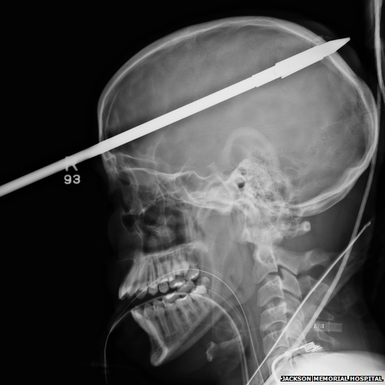 X-ray image of spear through head of Nasser Lopez (Jackson Memorial Hospital)