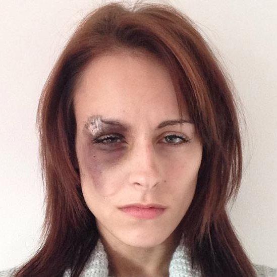 KatrinaKay Hayward partially blinded in Halloween attack BBC News