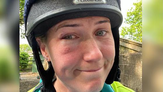 Image of Becci wearing a riding hat and grimacing into the camera. Her eyes are bloodshot and she had a large bruise forming under her right eye. 