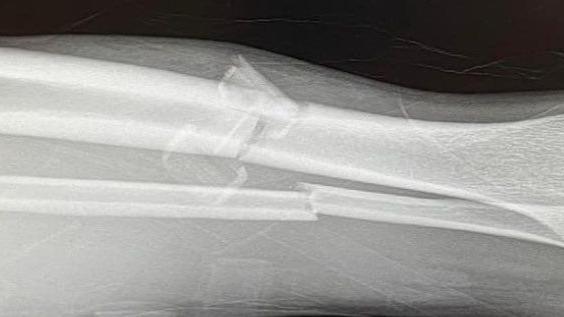 An x-ray image of broken bones