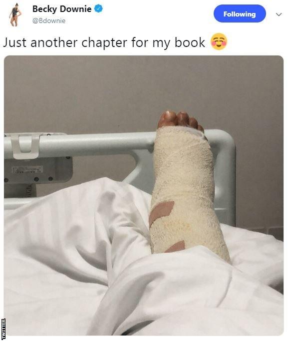 Becky Downie tweet showing her right ankle in plaster
