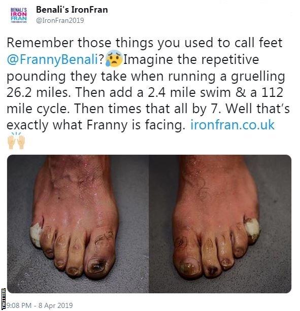 Tweet by Benali's IronFran showing Franny Benali's feet: "Remember those things you used to call feet? Imagine the repetitive pounding they take when running a gruelling 26.2 miles. Then add a 2.4 mile swim and a 112 mile cycle. Then times that all by 7. Well that's exactly what Franny is facing".