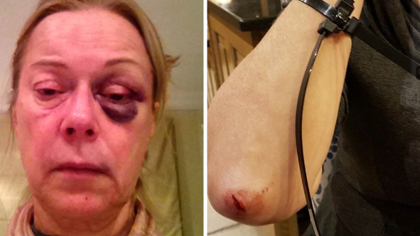 Injuries suffered by Susan Morris during an attack by the Night Watcher