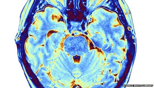 Brain scan. False-colour magnetic resonance imaging (MRI) scan of a human head containing a healthy brain, seen in horizontal view.