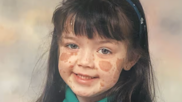 A school picture of Laura Kelly. She is smiling and has long black hair and a hairband. Her birthmarks are visible. 