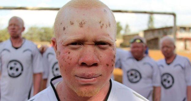 Nasoro is a member of the Albino United Football team.