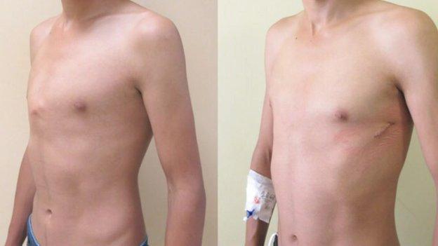 A patient's chest before and after the procedure has been completed