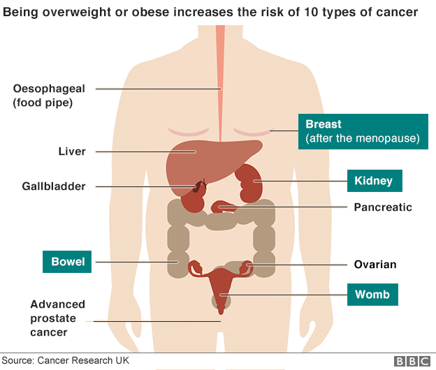 The 10 types of cancer linked to obesity