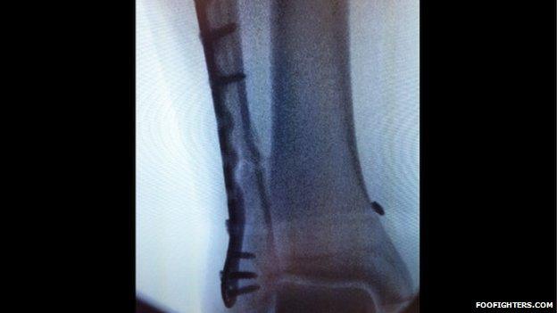 An X ray of Dave Grohl's leg