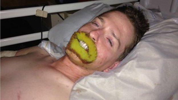 Alex in hospital with a green gauze over his lips