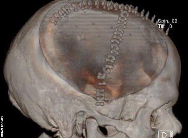 Brian Toomey's skull scan