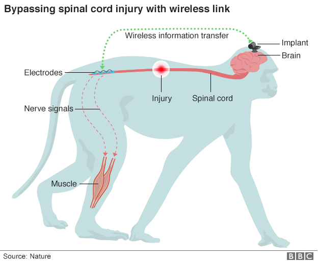 How the implant works