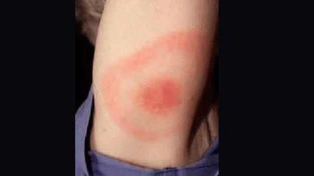 Tick bite