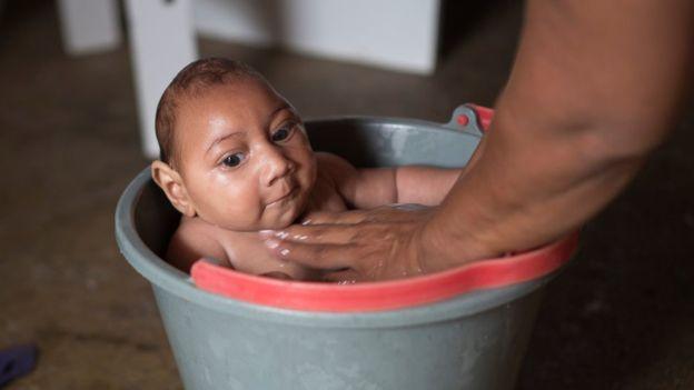 A baby with microcephaly is washed by its mother