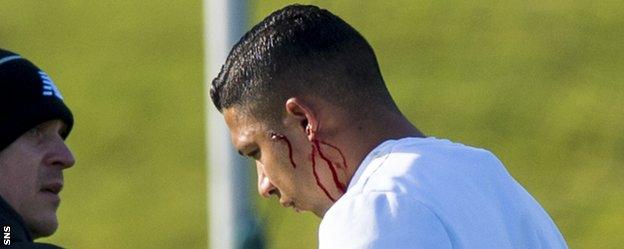 Celtic's Emilio Izaguirre with a cut ear