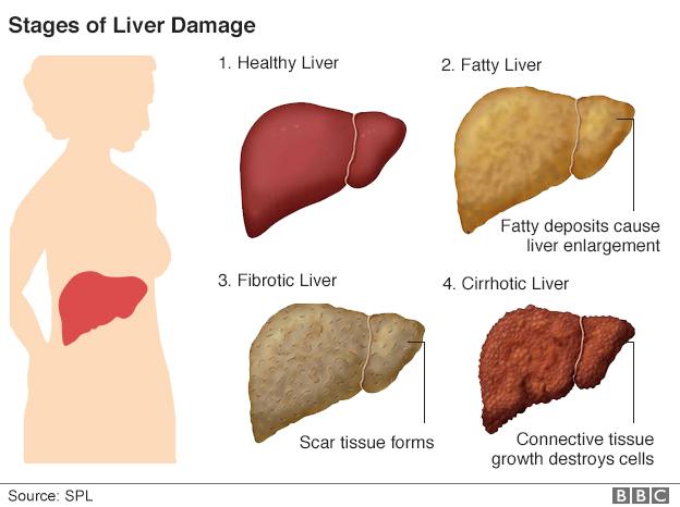 Liver damage