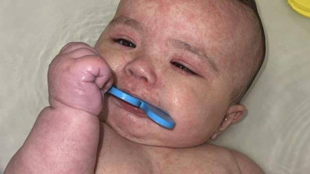 How Canada became the centre of a measles outbreak in North America