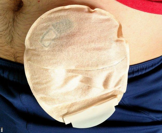 Stoma bag