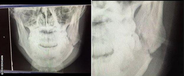 Eddie Hearn tweeted pictures of Scott Quigg's jaw