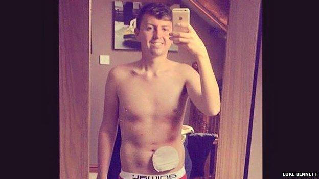 Luke Bennett's selfie with his colostomy bag