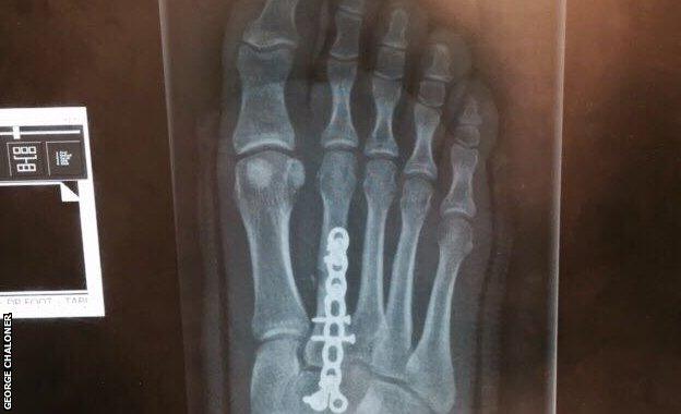 A screw in George Chaloner's foot