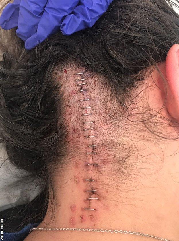Zoe De Toledo scar