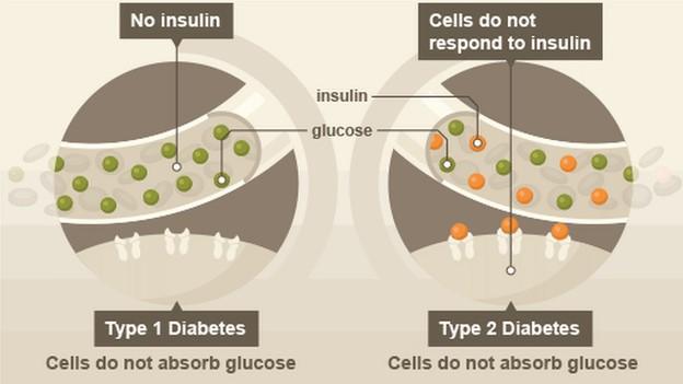 Diabetes illustration