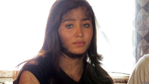 The struggles of the world's hairiest family - BBC News