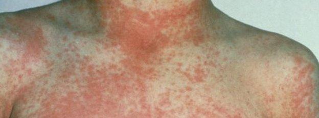 A scarlet fever rash