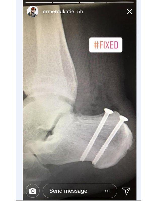 Katie Ormerod's X-ray