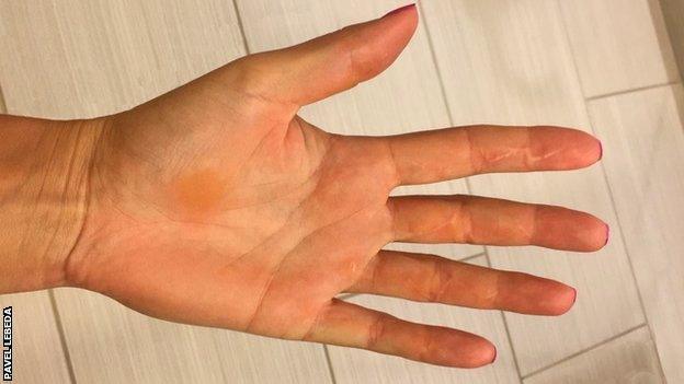 Petra Kvitova's hand, after healing