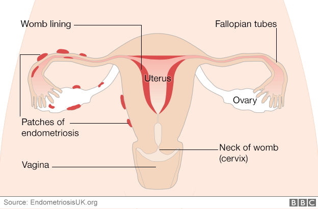 A diagram showing how endometriosis builds up around the fallopian tubes and ovaries