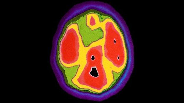 Brain scan of four-year-old with autism