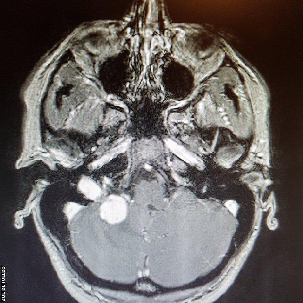 Zoe De Toledo brain scan