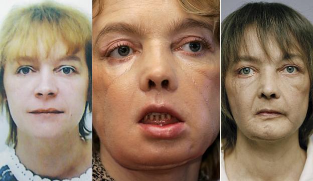 A composite image of Isabelle Dinoire showing her before (2001), just after the operation (2006), and in 2009. Left and centre images AP; right image Julien Chatelin, Rex Features