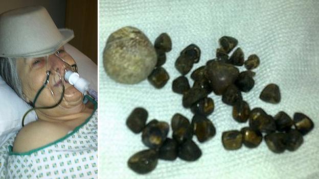 Anita Crawley and her gallstones