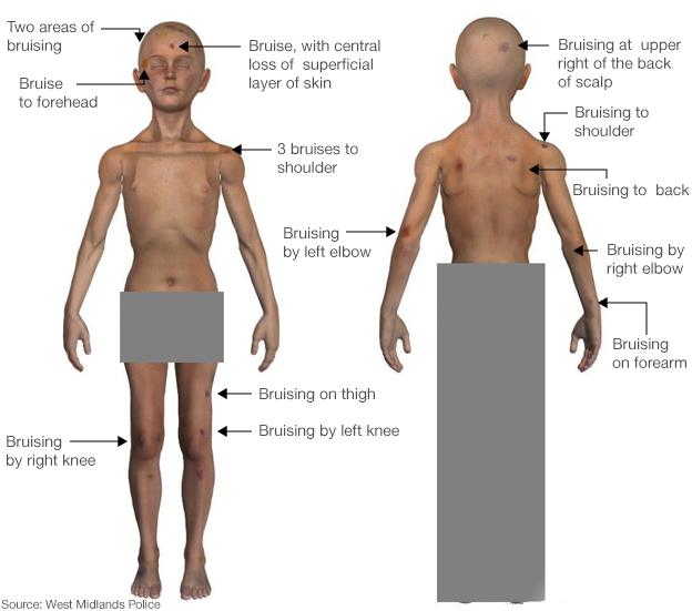 Daniel Pelka's injuries