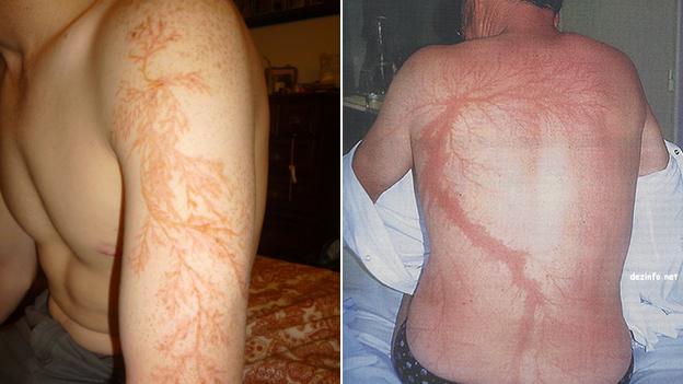 Two photos of men with lightning injuries that look like flower or tree branches