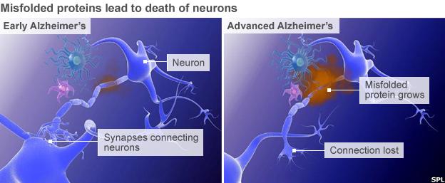 Alzheimer's graphic