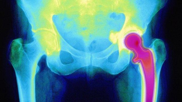 Hip replacement x-ray