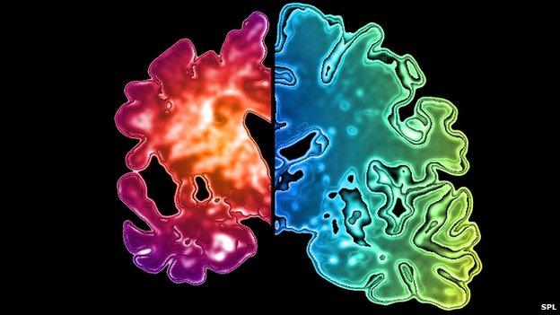 Loss of tissue in a diseased brain compared with a healthy one