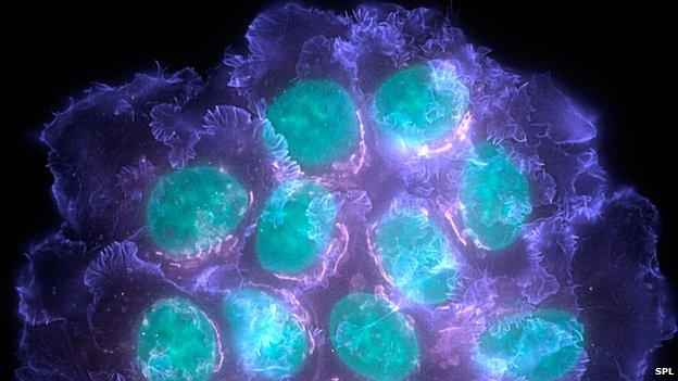 Breast cancer cells