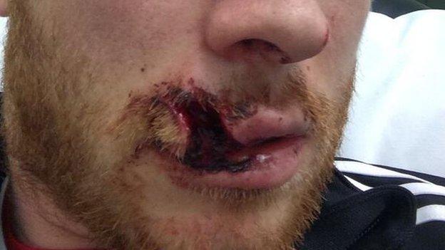 Mark Reynolds' stitched lip