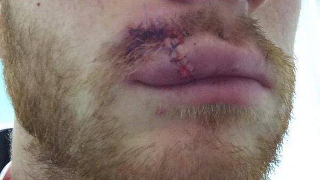 Mark Reynolds' stitched lip