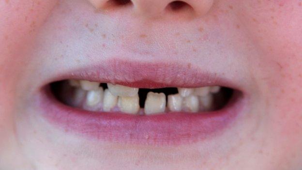 A young boy shows a gap in his teeth where two primary teeth have come out