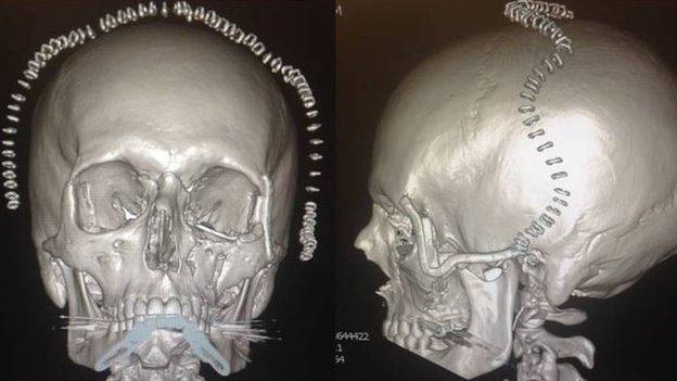 Two views of Stephen Power's skull with temporary staples after the operation