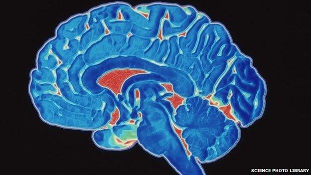 A coloured CT scan image of a human brain