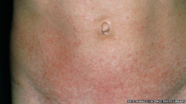 Scarlet fever rash