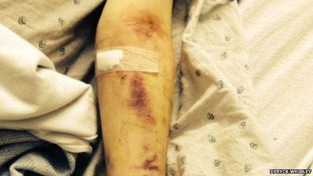 Deryck Whibley's arm, with sores on it