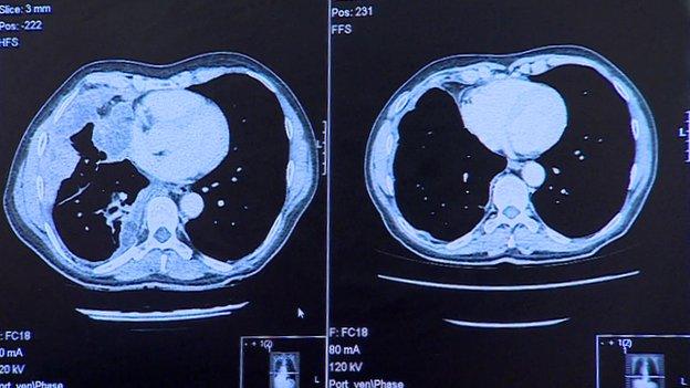 scan of lungs